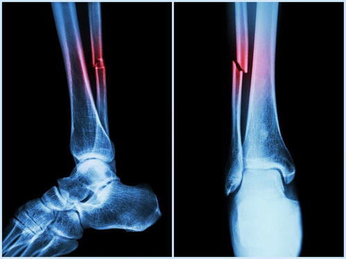 New machine algorithm can identify heart, fracture risks with routine bone scans